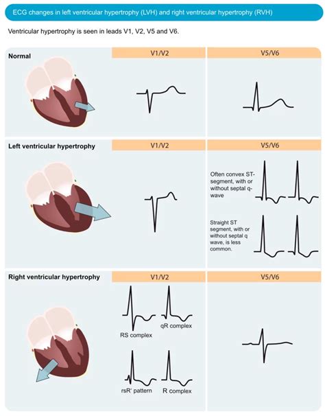 lv overload on ekg|ecg changes in lvh.